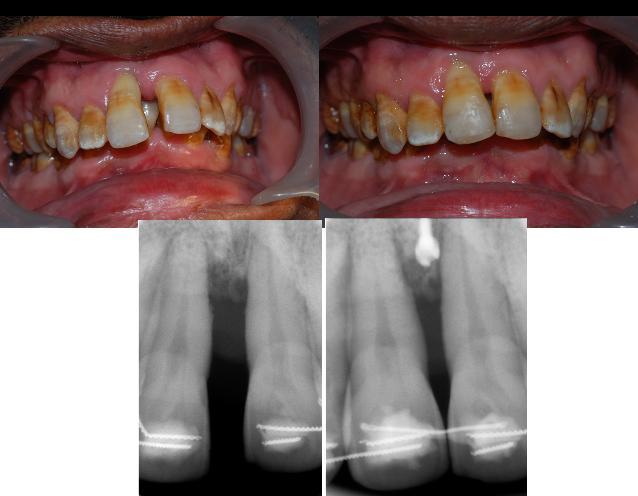 incisor intrusion with microimplants