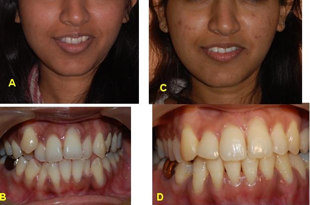 Facial pict pre & post treatment