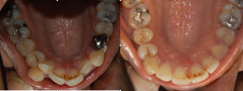 Occlusal views pre and post trt