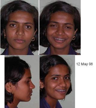 Facial pict mid treatment